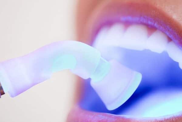 bonding dental
