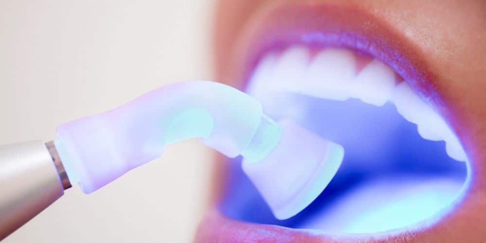 bonding dental