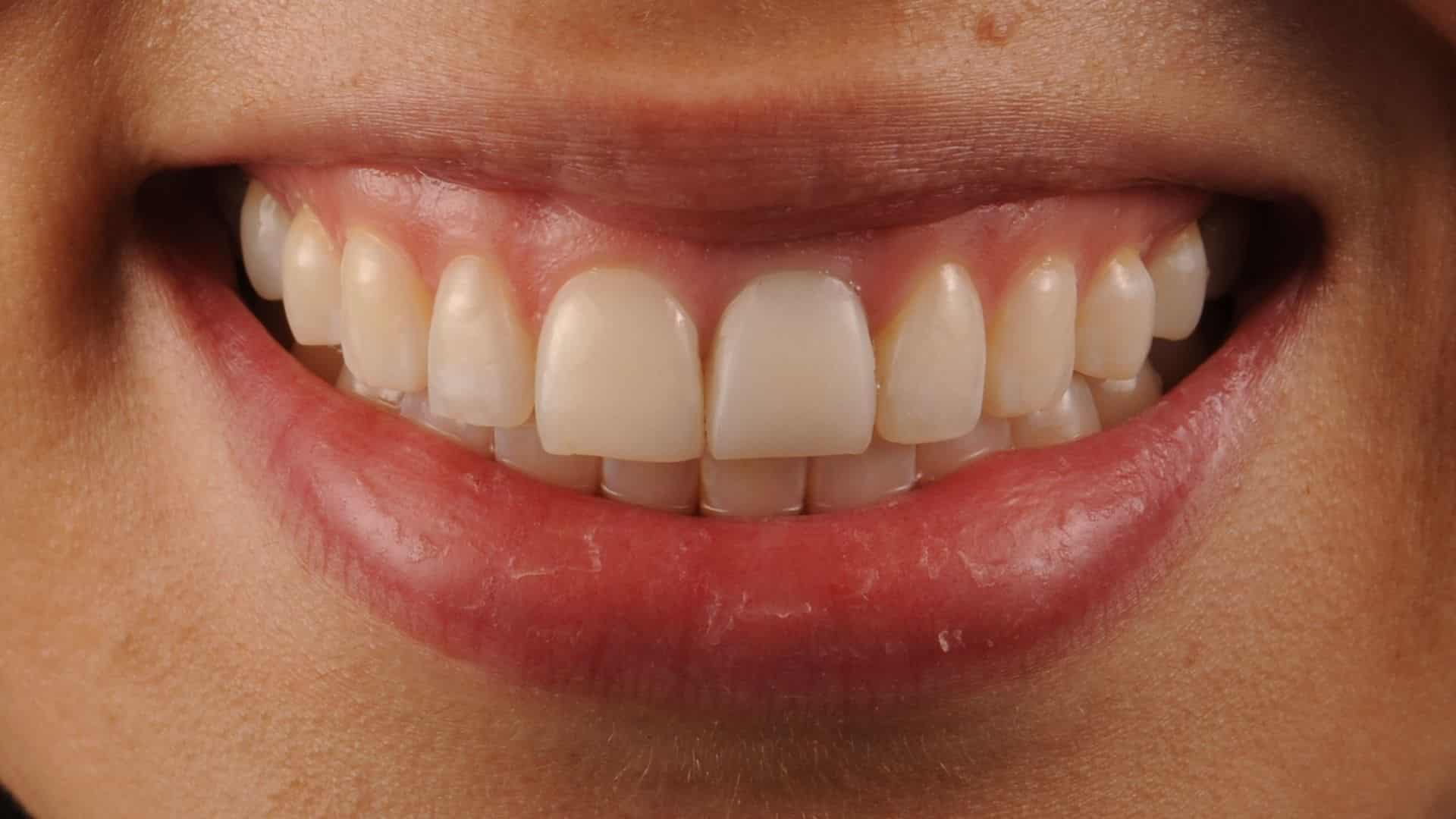 carillas dentales 10 despues