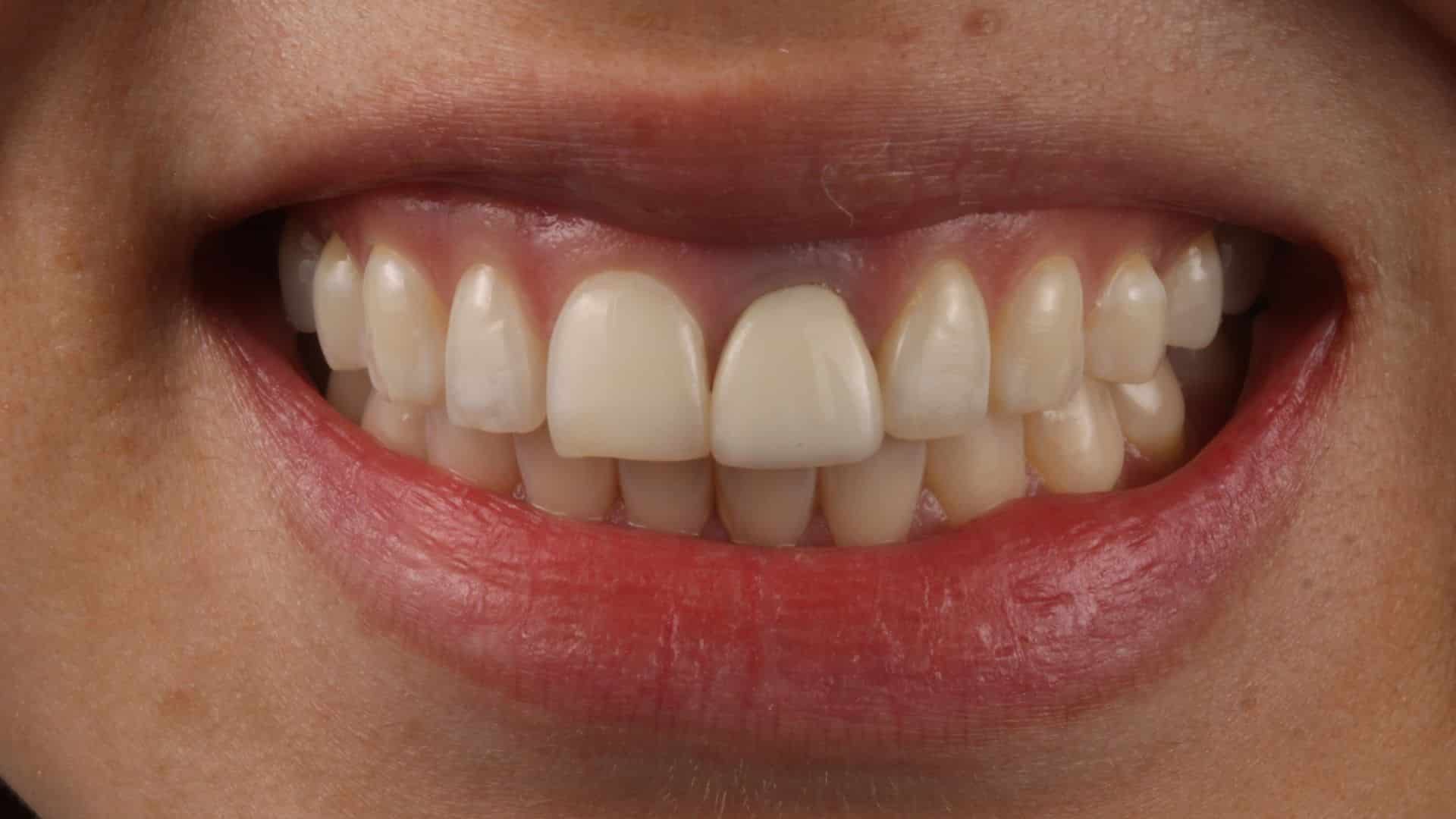 carillas dentales 10 antes