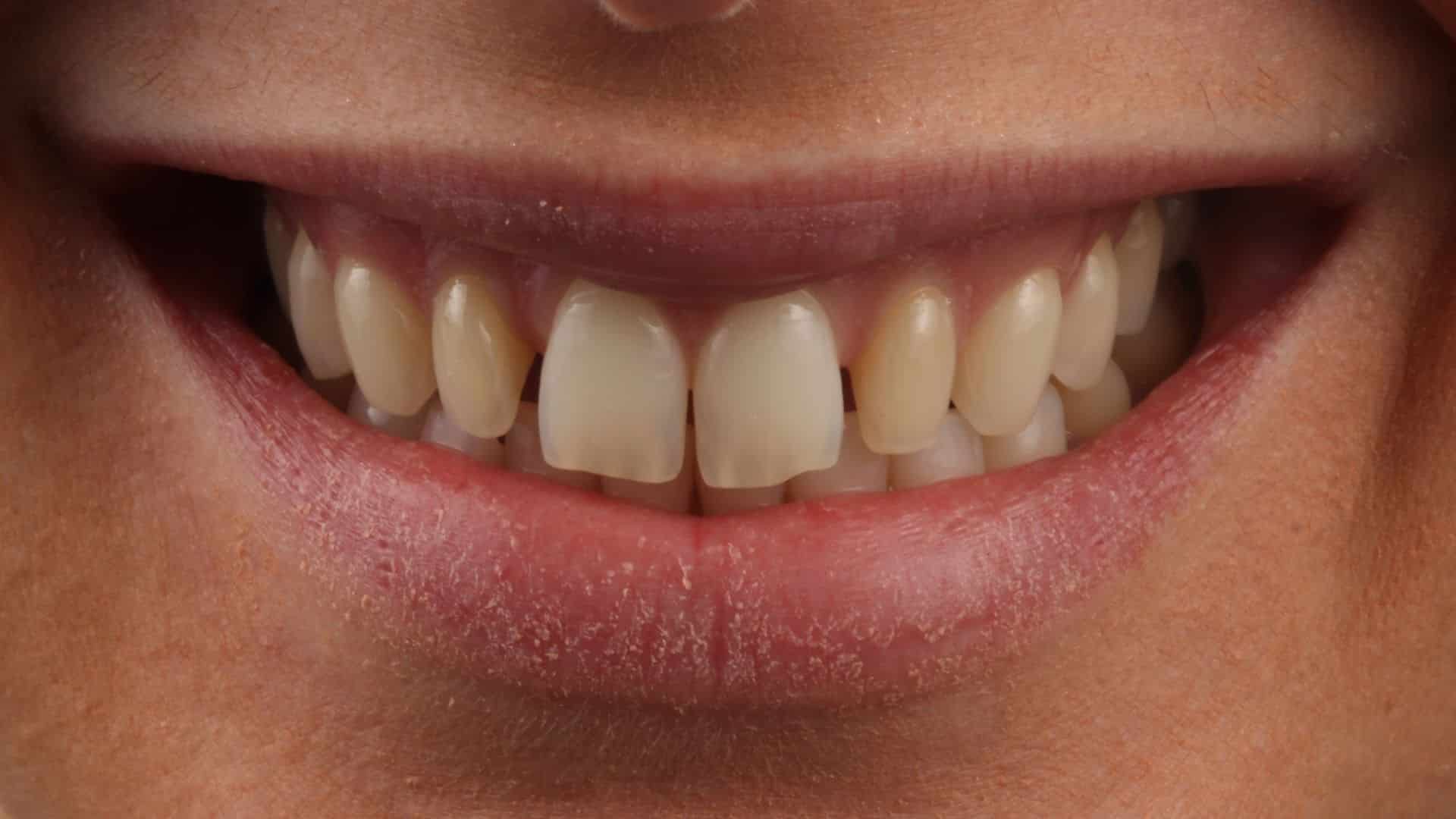 carillas dentales 5 antes