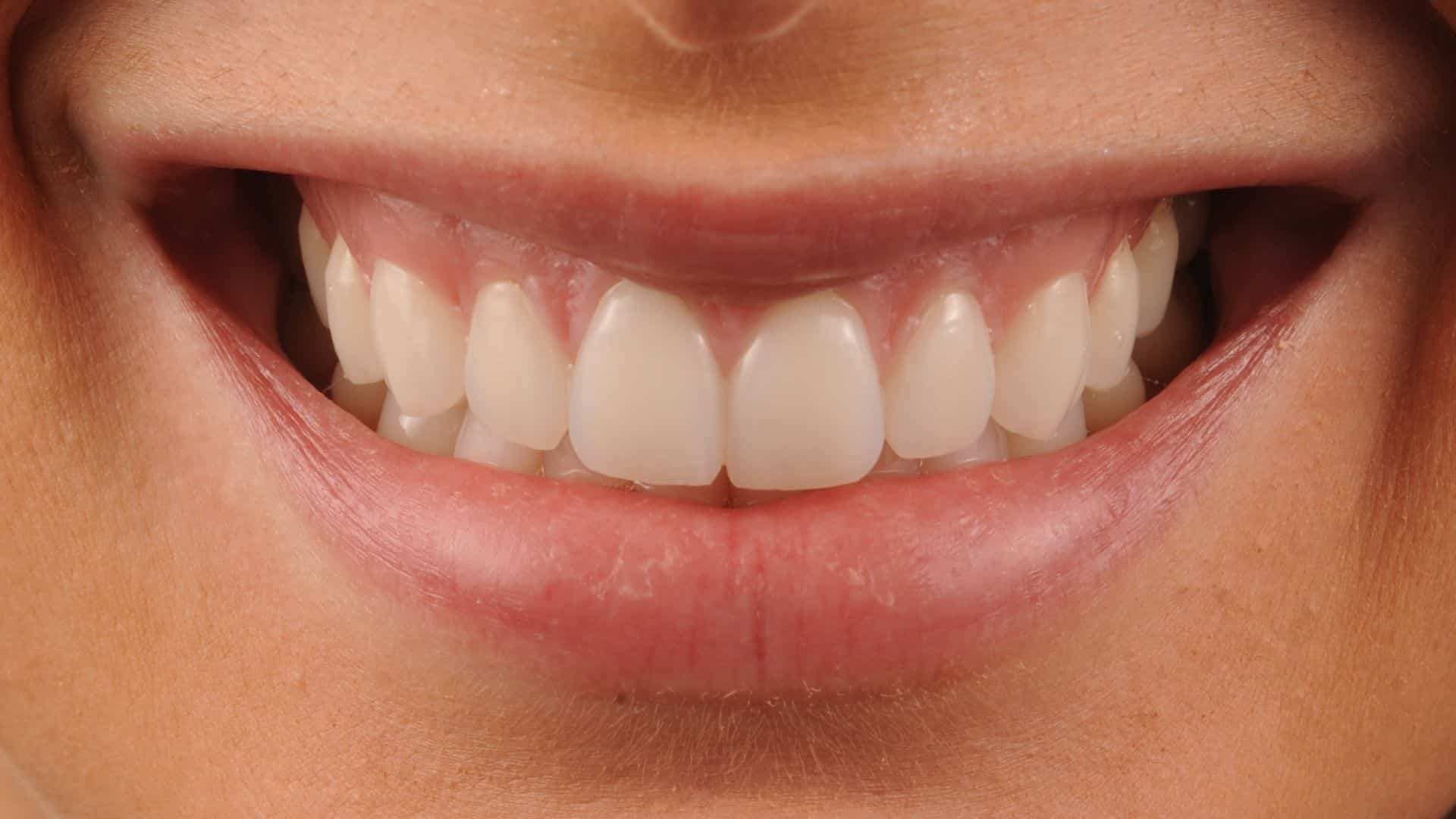 carillas dentales 5 despues