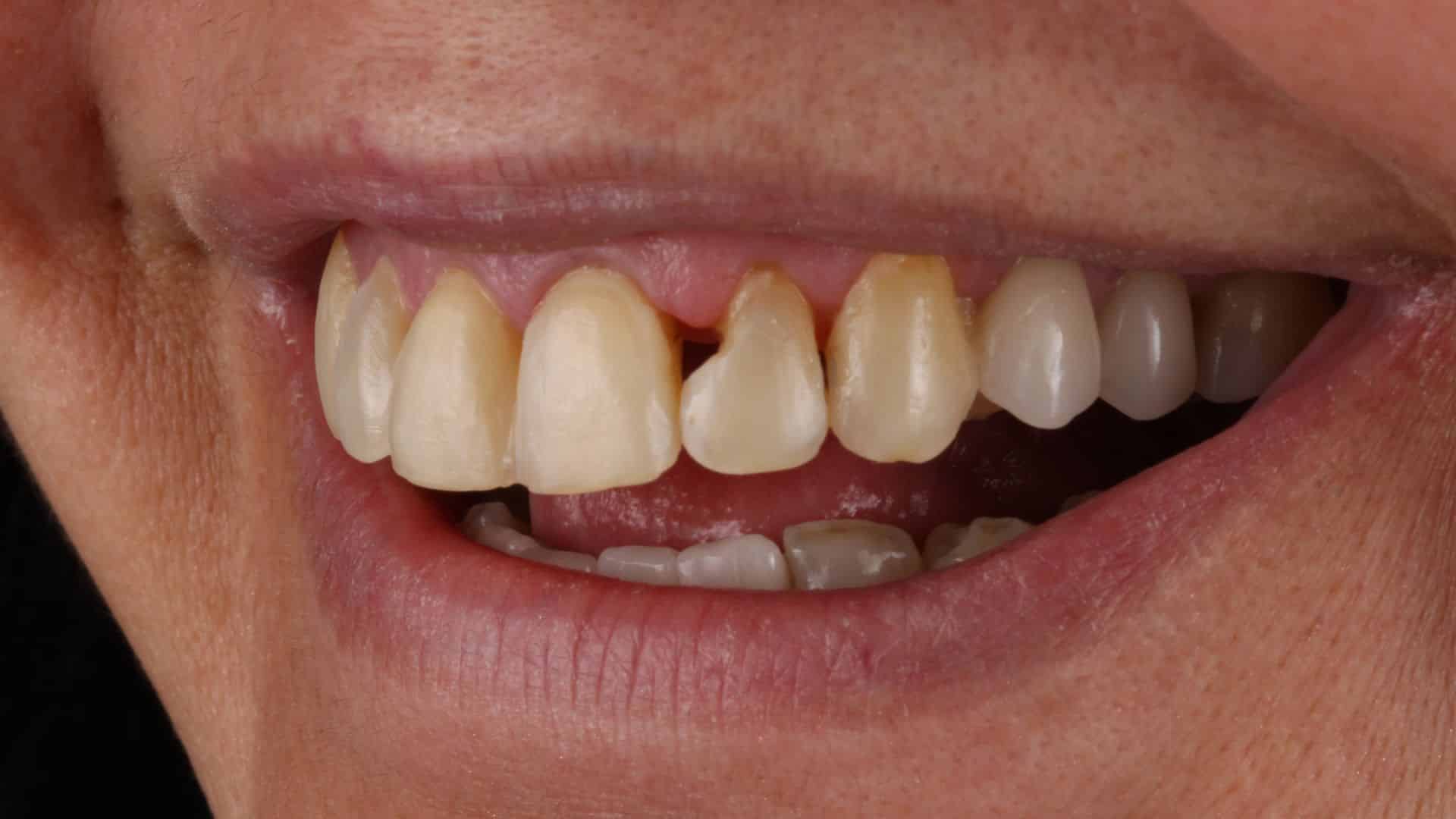 carillas dentales 6 antes