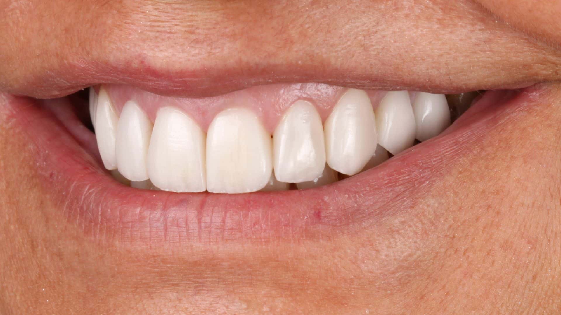 Casos reales de carillas dentales