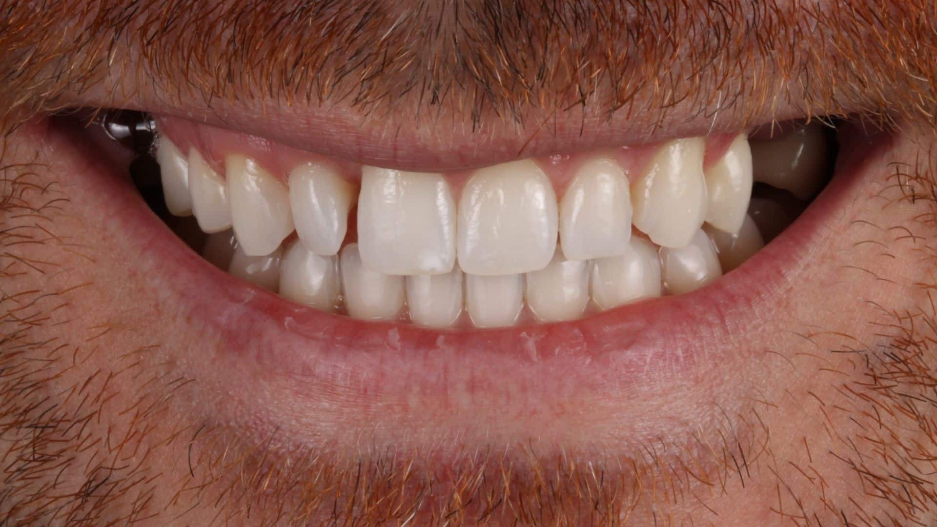 carillas dentales 9 antes