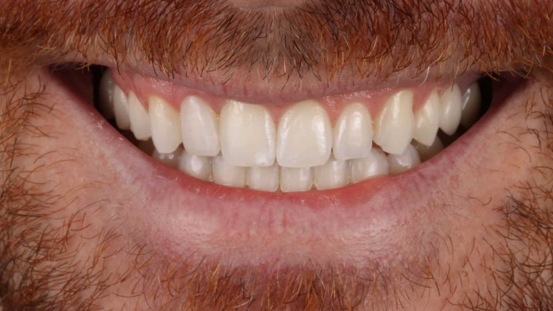 carillas dentales 9 despues
