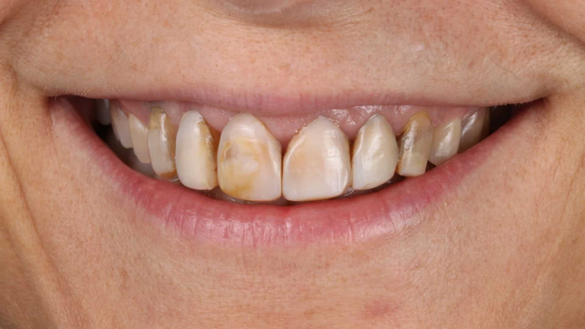 casos carillas dentales 1 antes