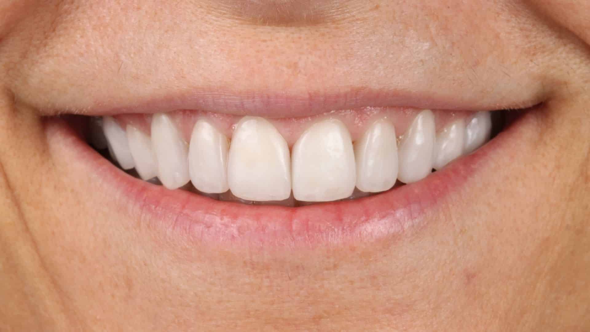 casos carillas dentales 1 despues