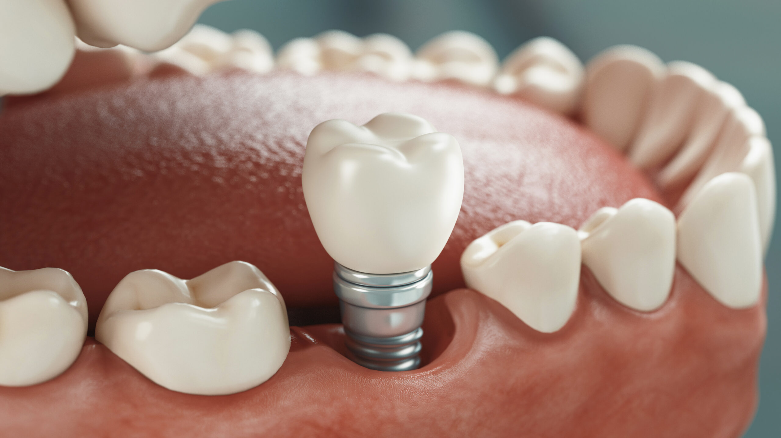 cuánto dura un implante dental