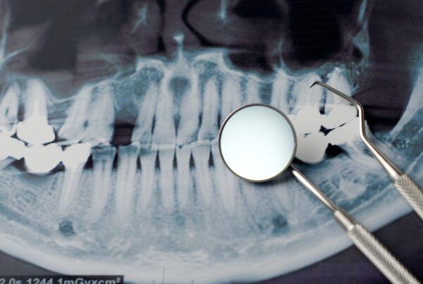 Reabsorción ósea dental: causas, consecuencias para los implantes y soluciones - Clínica Ruiz de Gopegui Reabsorción ósea dental: causas y soluciones para implantes en Madrid.