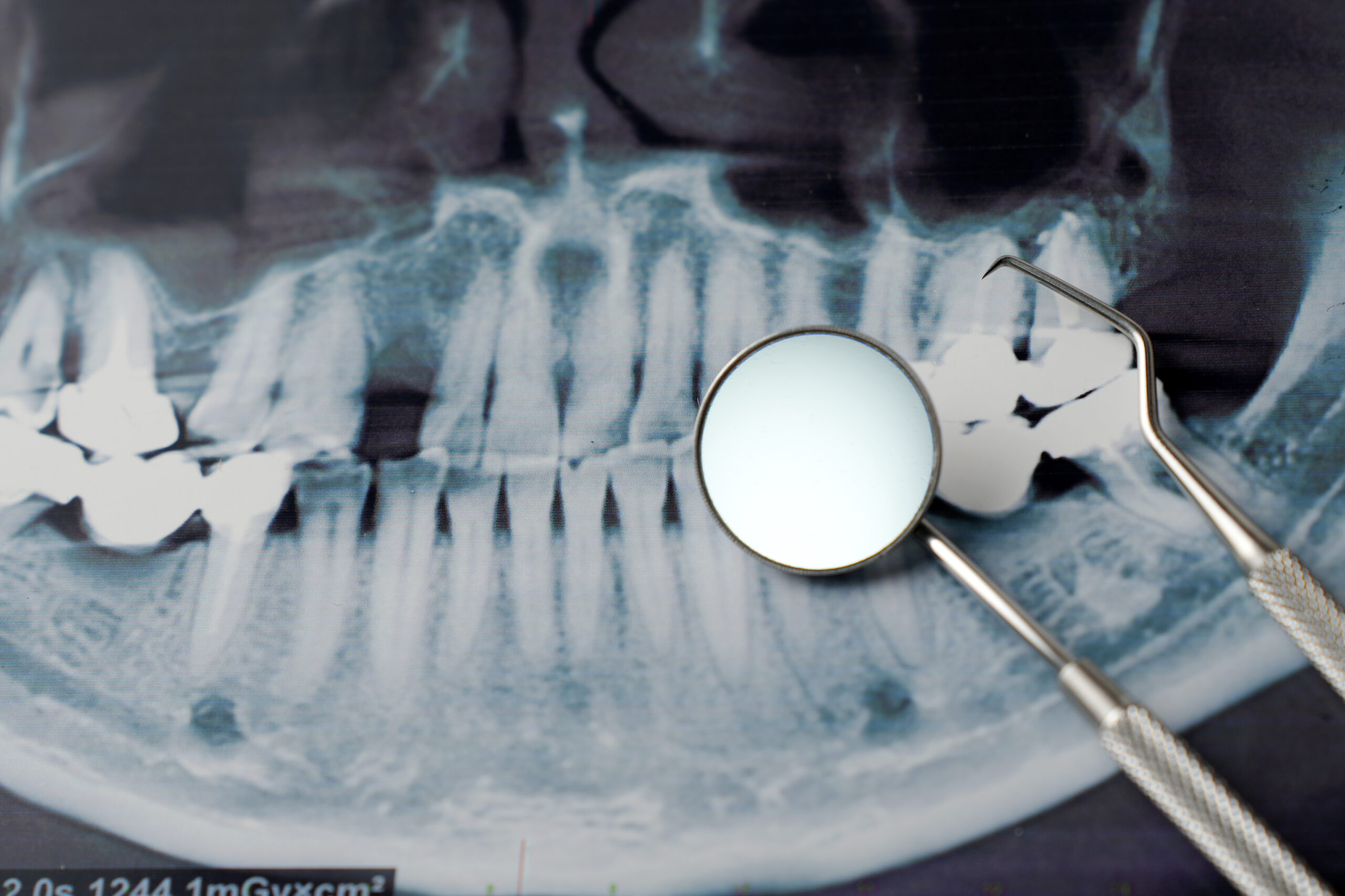 Reabsorción ósea dental: causas y soluciones para implantes en Madrid.