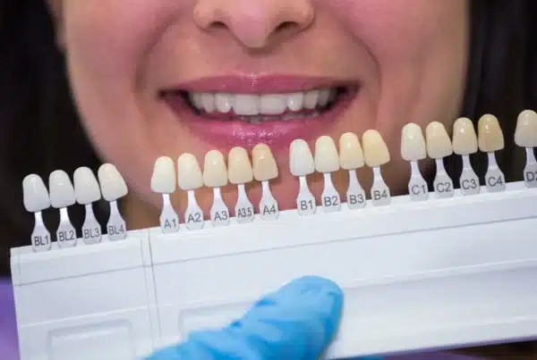 ¿Cuánto duran las carillas dentales? Mantenimiento y vida útil - Clínica Ruiz de Gopegui cuánto duran las carillas dentales