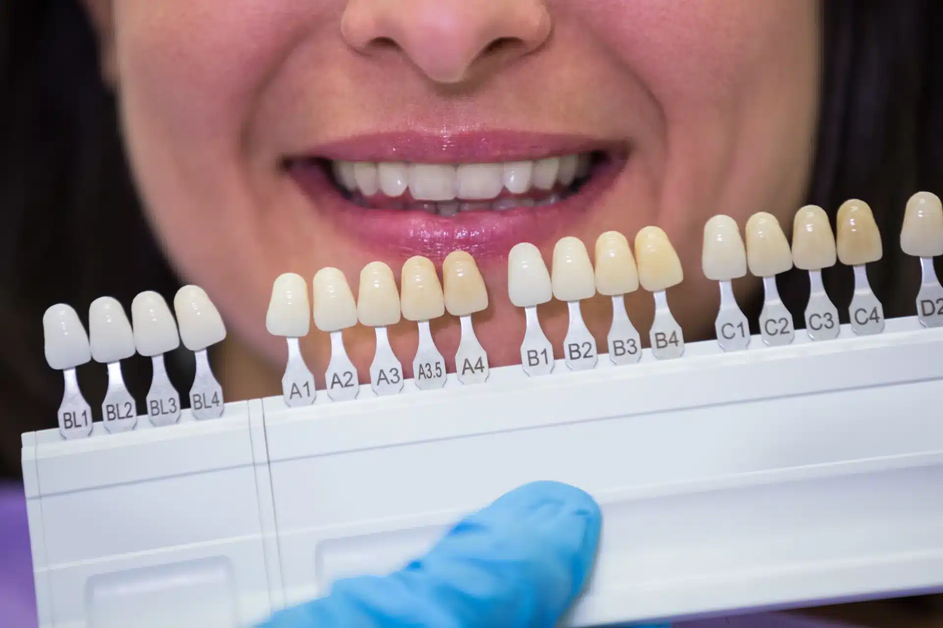 cuánto duran las carillas dentales
