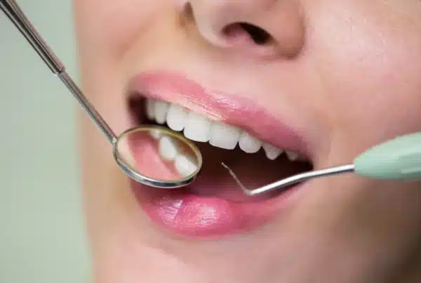 Sondaje periodontal realizado con sonda milimetrada para medir la profundidad de bolsa periodontal