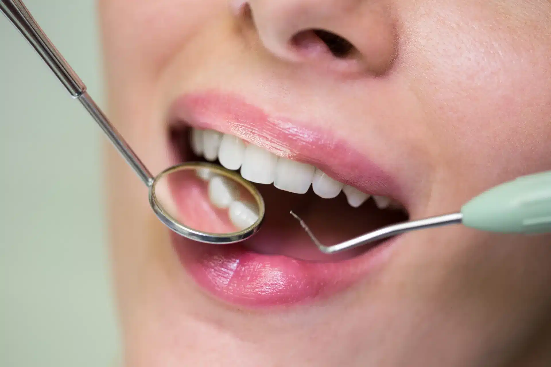 Sondaje periodontal realizado con sonda milimetrada para medir la profundidad de bolsa periodontal