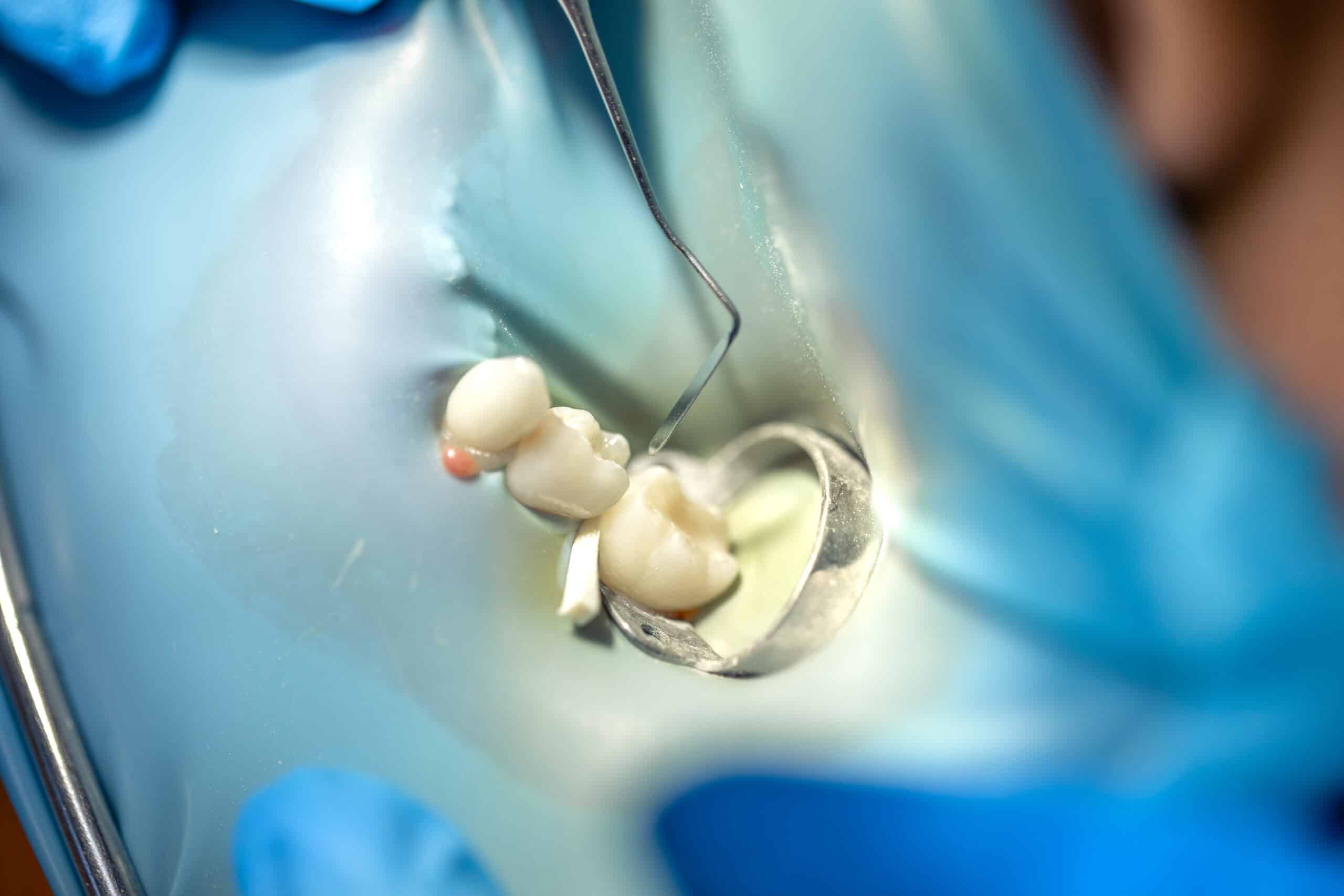 Coronas de disilicato de litio e.max fabricadas con Cerec en clínica dental Madrid