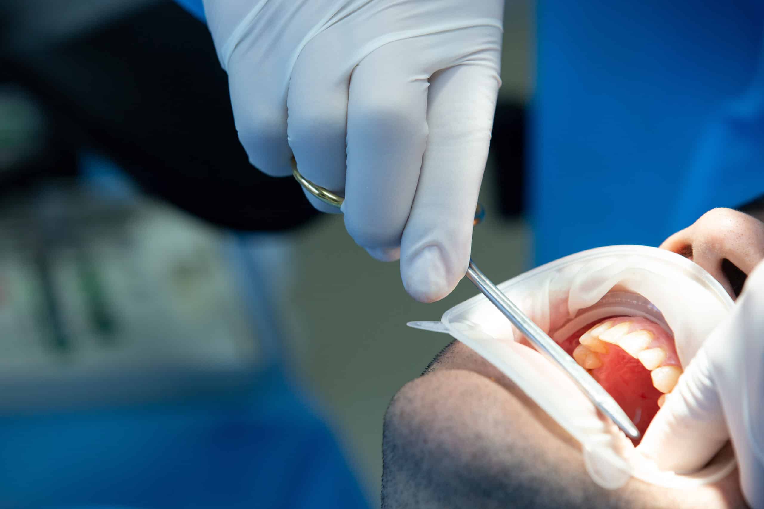Microcirugía periodontal con lupas de magnificación en clínica dental Madrid