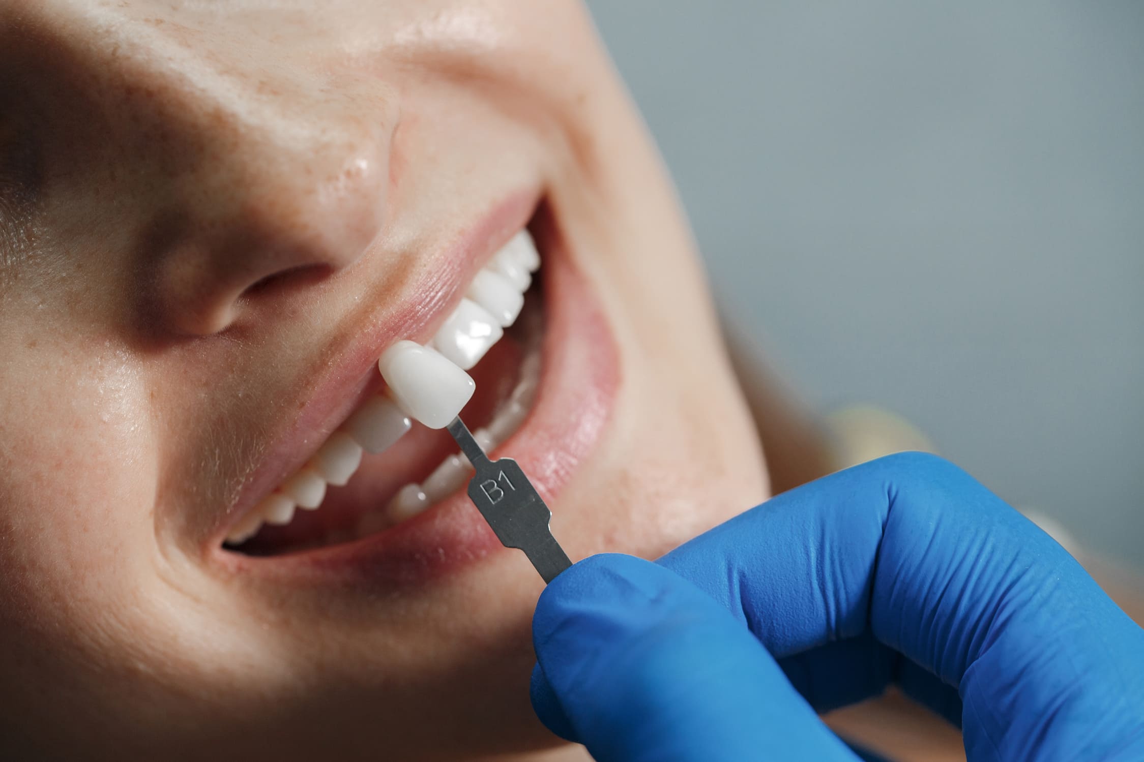 carillas dentales de porcelana clínica dental ruiz de gopegui
