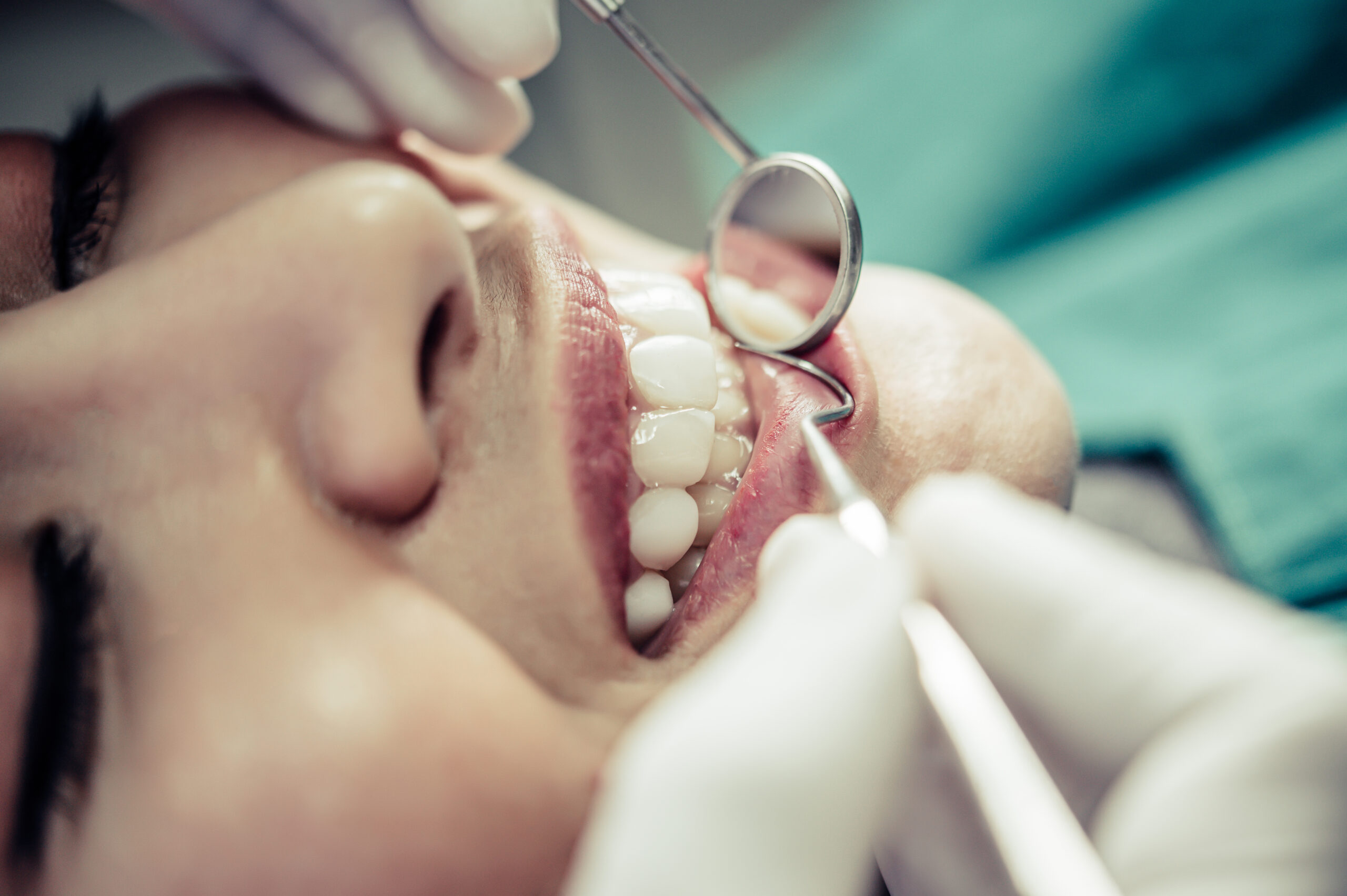 Cirugía plástica periodontal e injerto de encía en Madrid Dr. Ruiz de Gopegui