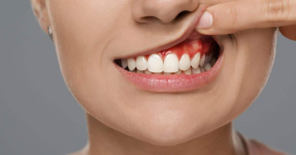 Flemón dental