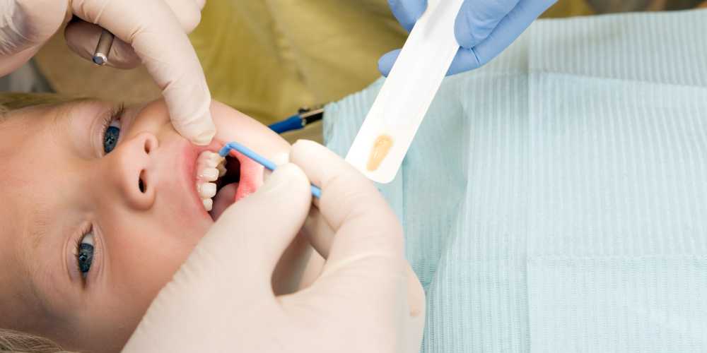 fluorosis dental en niños