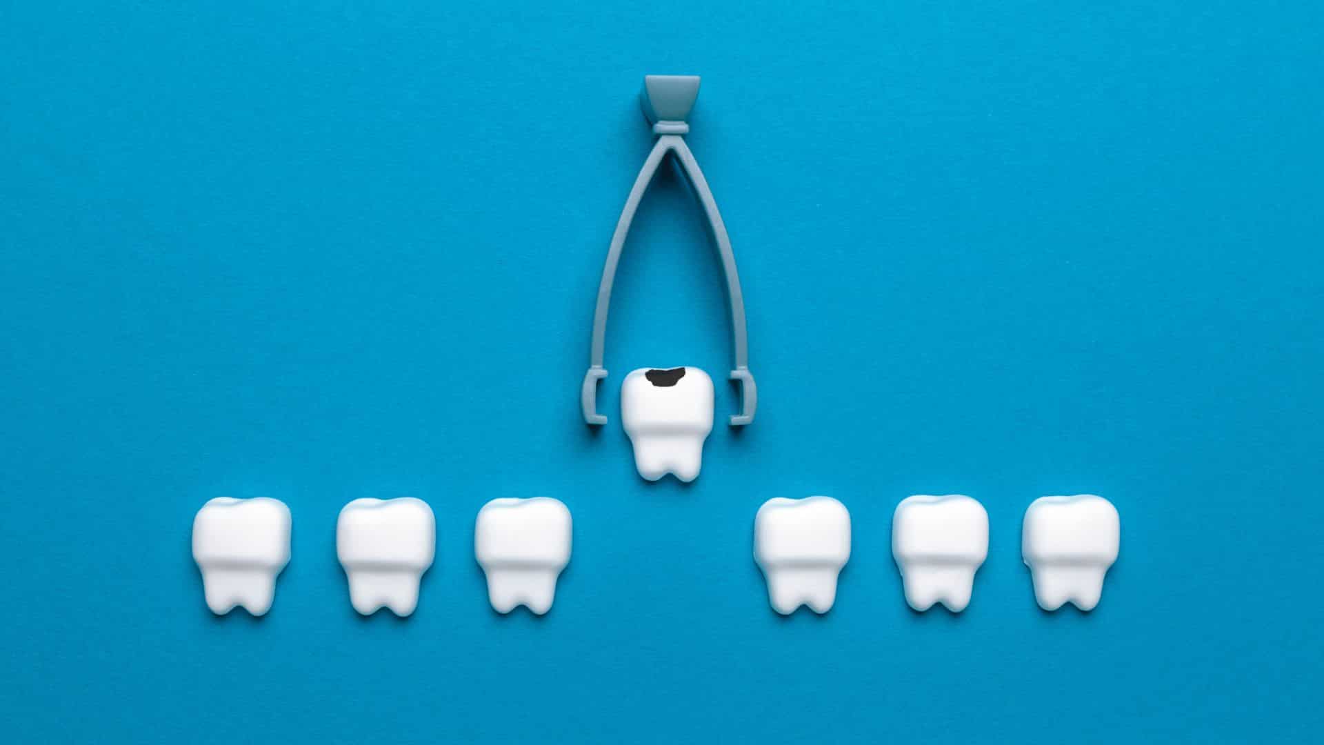 Pérdida dental clinica dental ruiz de gopegui