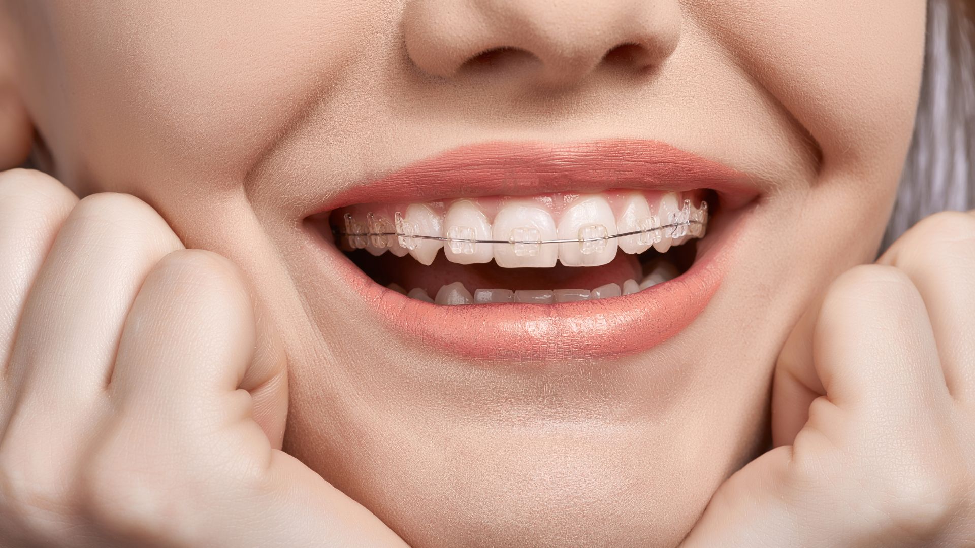 brackets clinica dental ruiz de gopegui