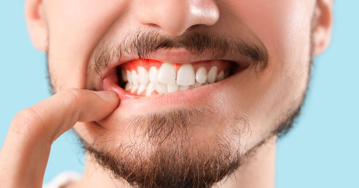 Gingivitis y periodontitis