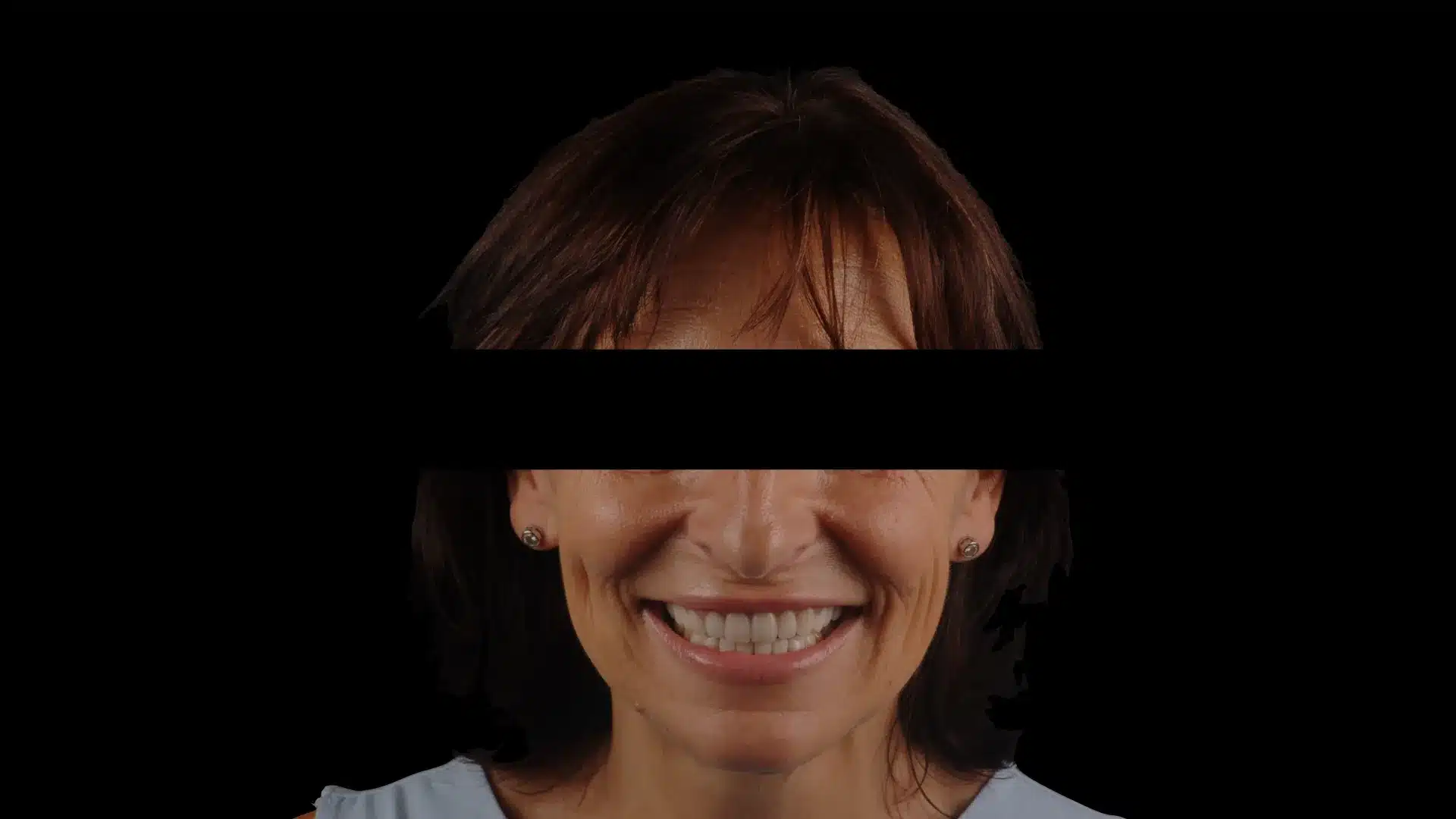 Carillas Dentales - Clínica Ruiz de Gopegui Retrato de primer plano de la sonrisa de una paciente mayor con carillas dentales superiores e inferiores, mostrando una dentadura blanca, alineada y natural tras un tratamiento periodontal y estético.