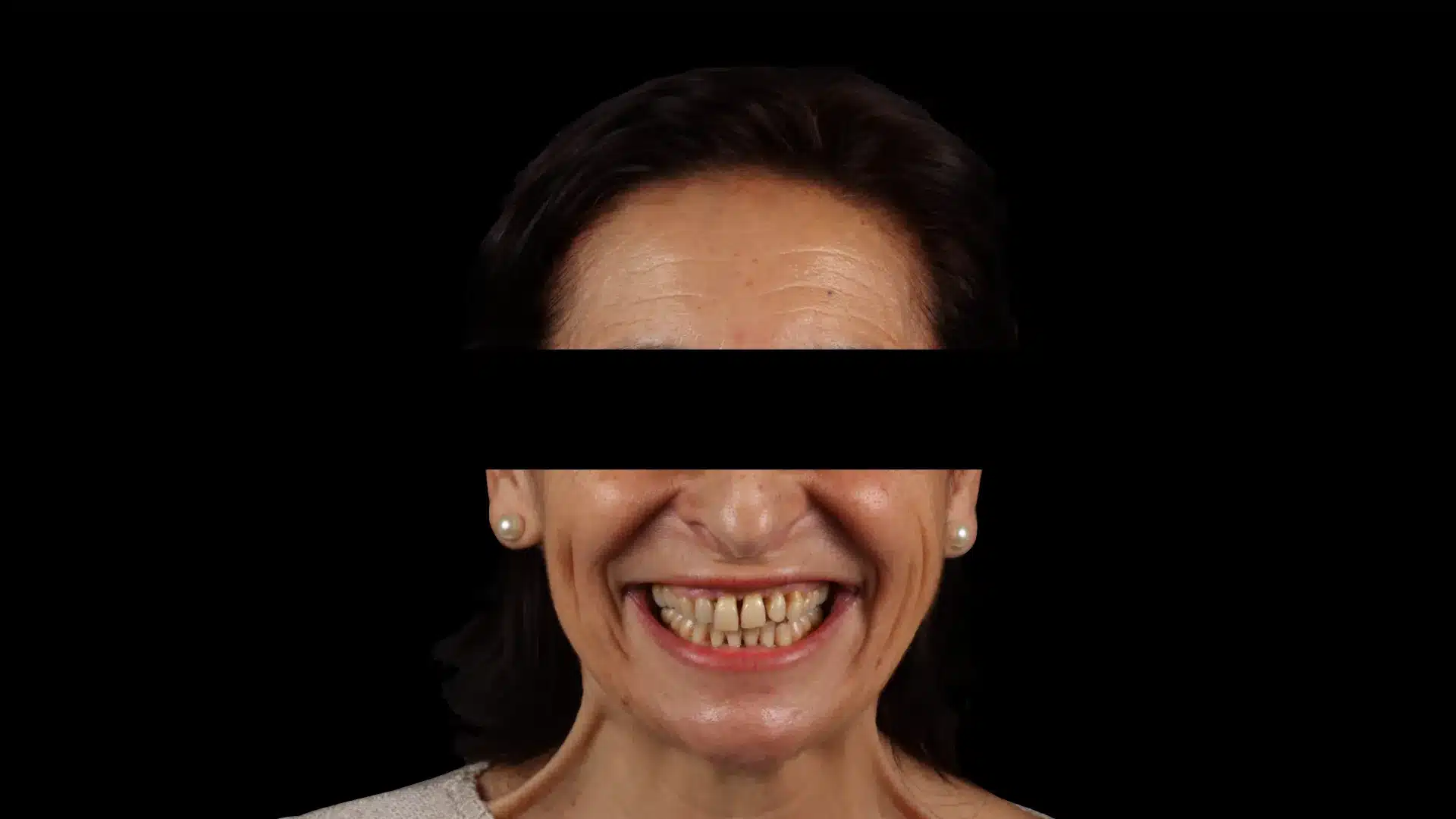 Carillas Dentales - Clínica Ruiz de Gopegui Retrato de primer plano de la sonrisa inicial de una paciente de 65 años con enfermedad periodontal severa, mostrando dientes oscurecidos, retracción de encías y presencia de espacios negros ("black triangles") entre los dientes.