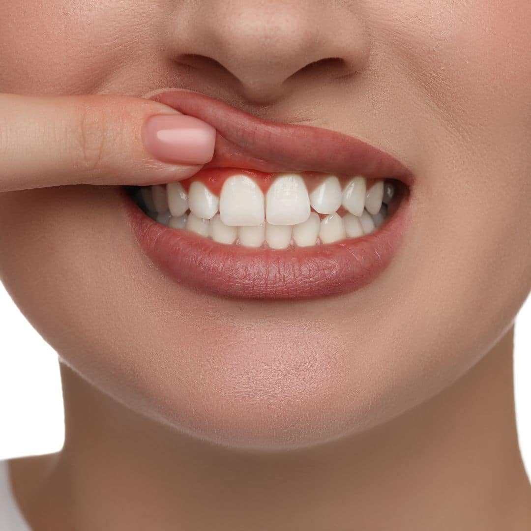 gingivoplastia clinica dental ruiz de gopegui