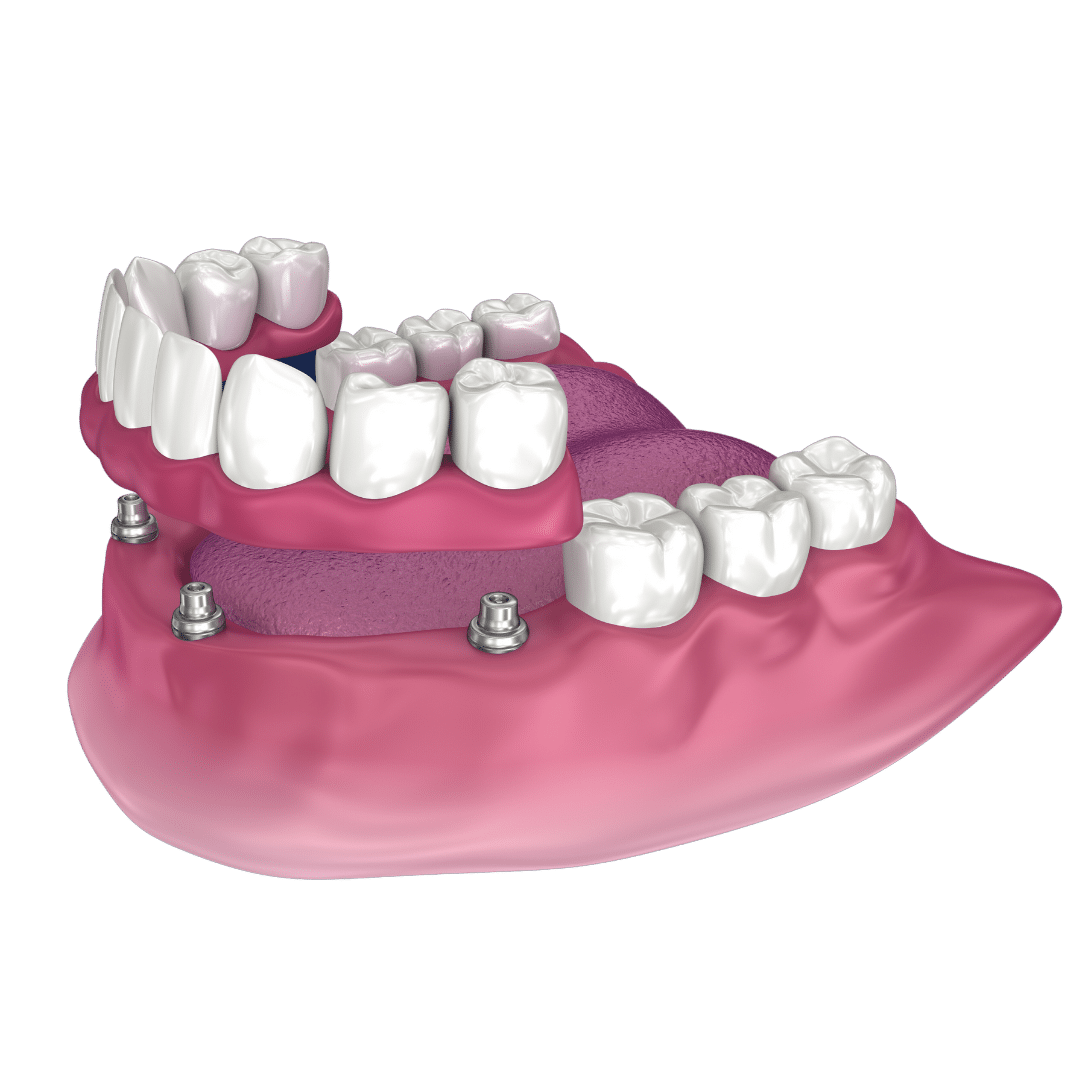 sobredentadura clinica dental ruiz de gopegui