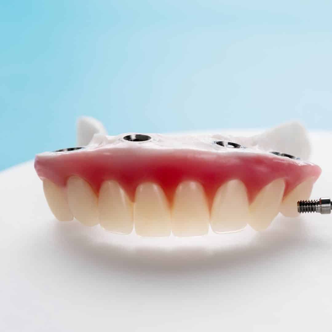 sobredentadura clinica dental ruiz de gopegui