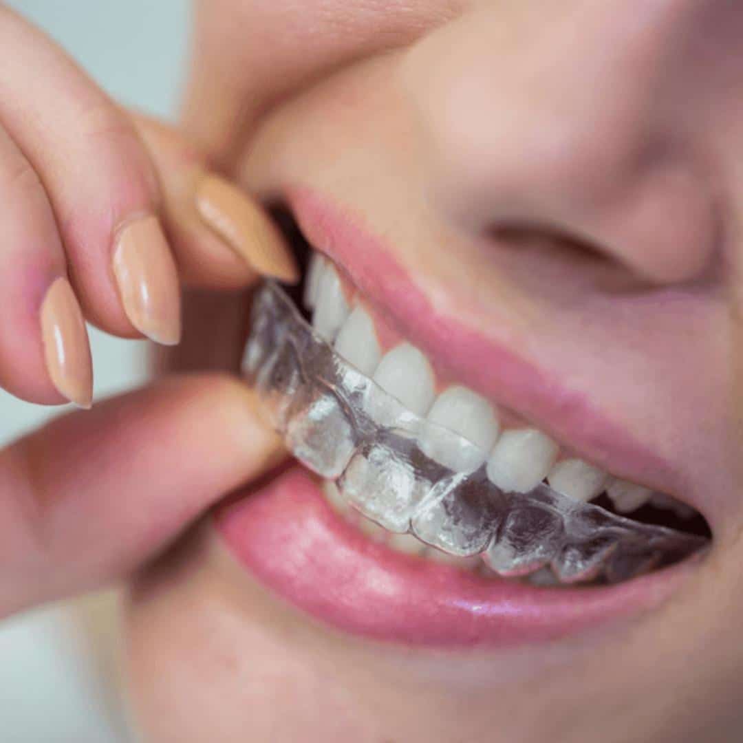 Retenedor removible invisalign Clinica dental ruiz de gopegui