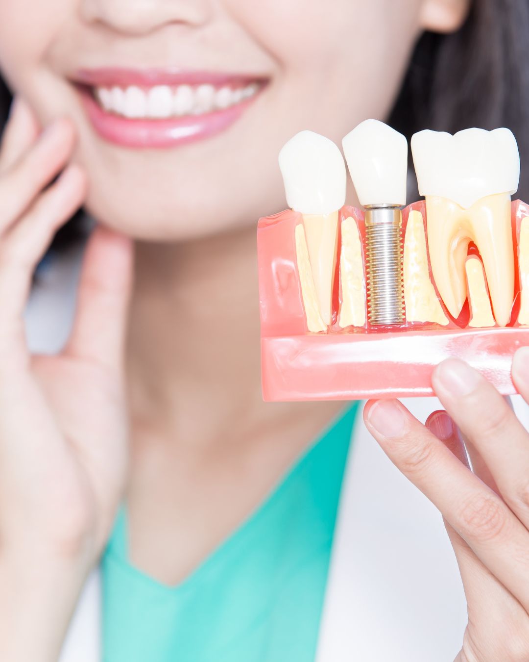 mini-implantes dentales