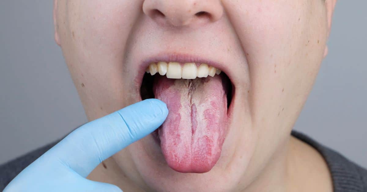 lengua saburral