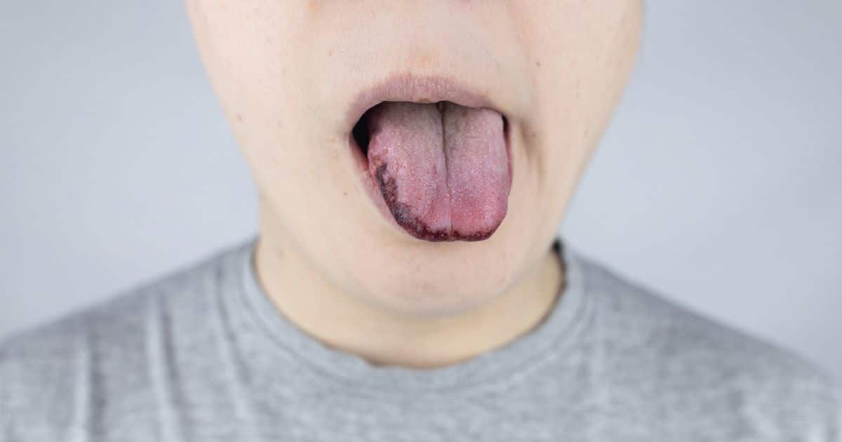 lengua sucia