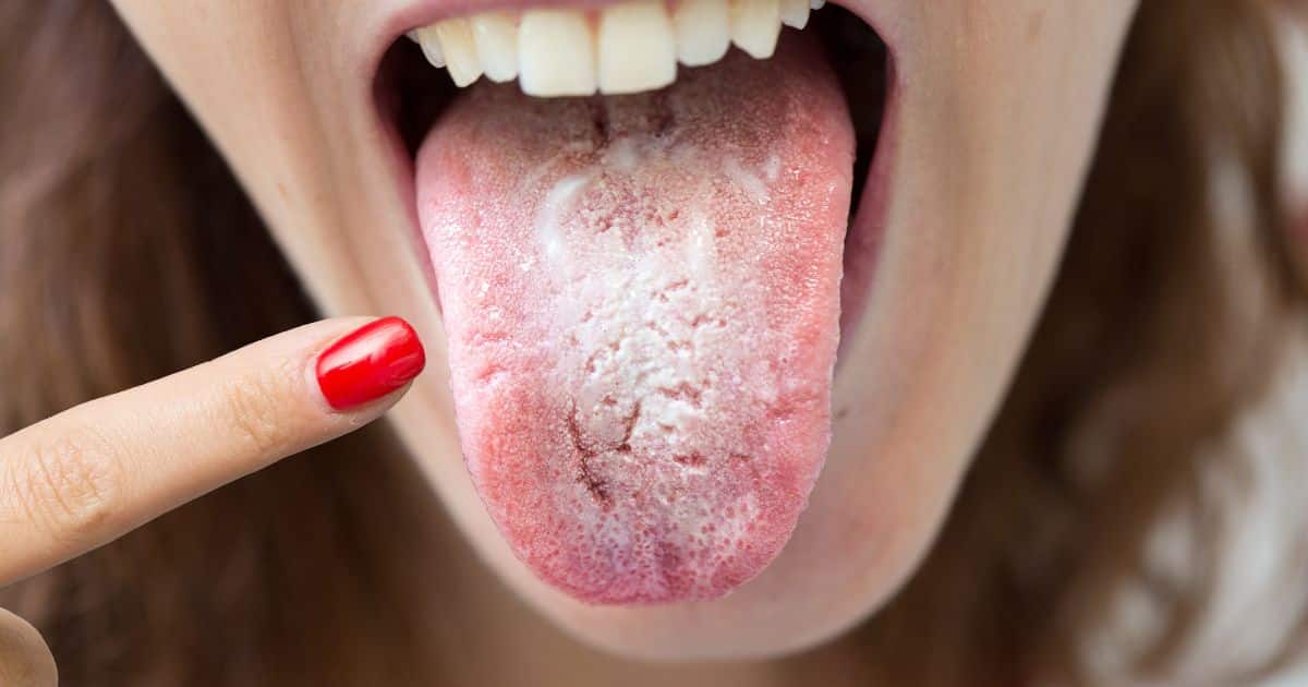 liquen plano oral