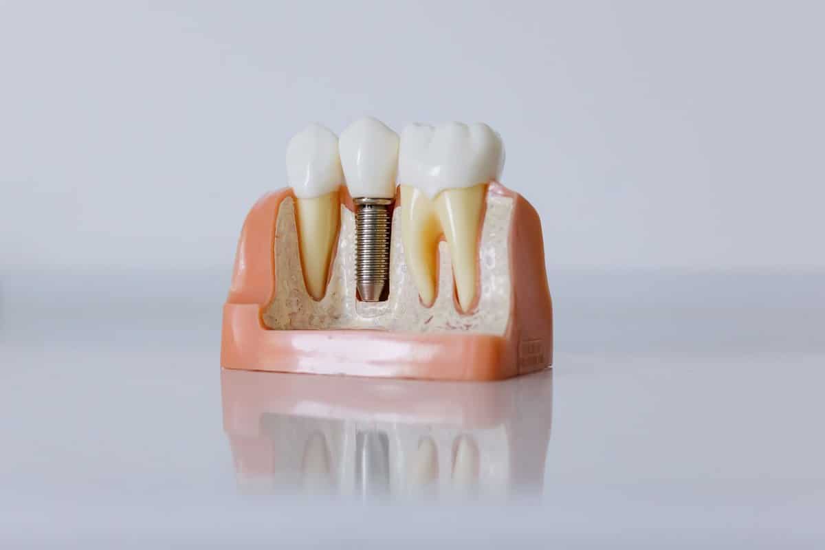 Modelo de un implante dental con su corona, para explicar en qué consiste el tratamiento