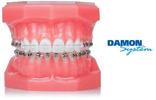 autoligable damon clinica dental ruiz de gopegui