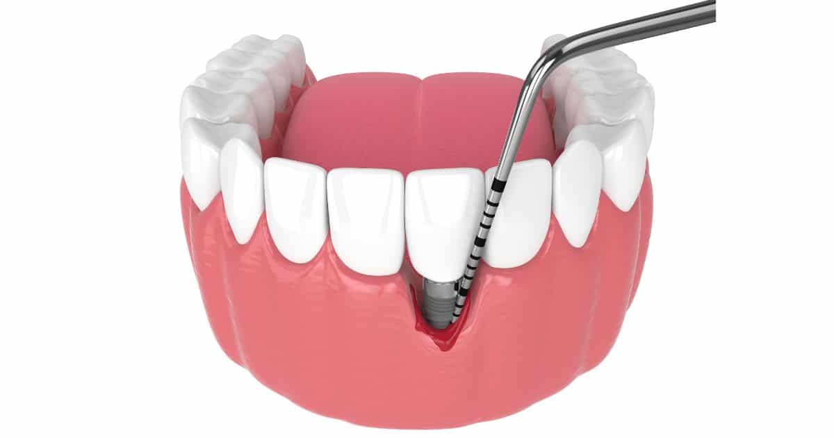 periimplantitis