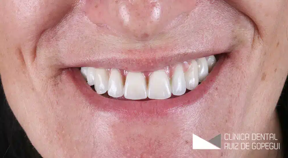 periodontitis sin saberlo