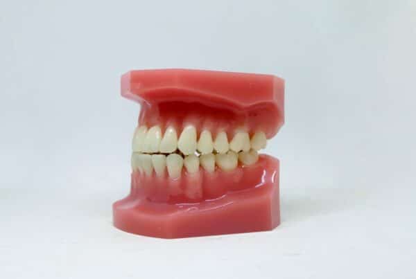Apiñamiento dental
