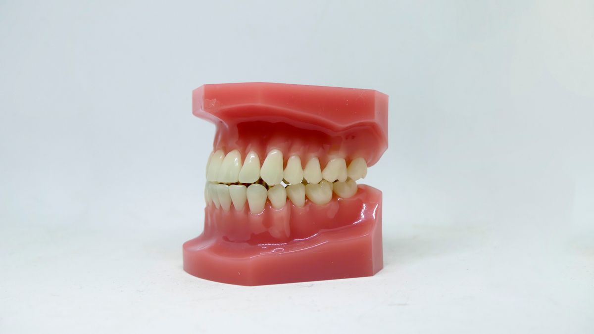 Apiñamiento dental