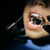 Niño en revisión dental por posible impacto de respiración oral