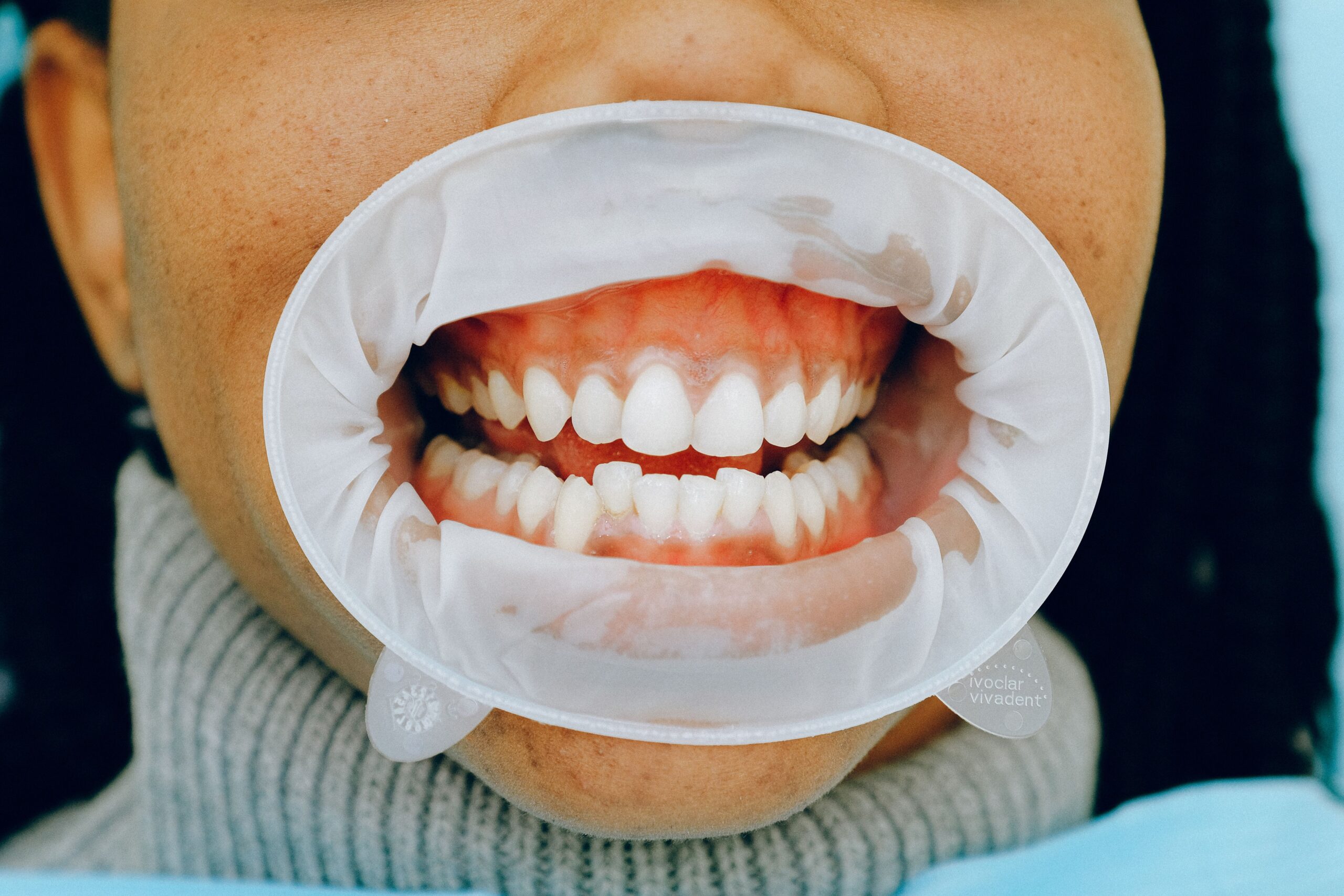 implante dental con periodontitis