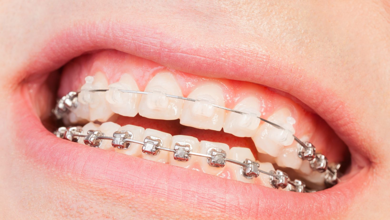 brackets de zafiro clinica dental ruiz de gopegui