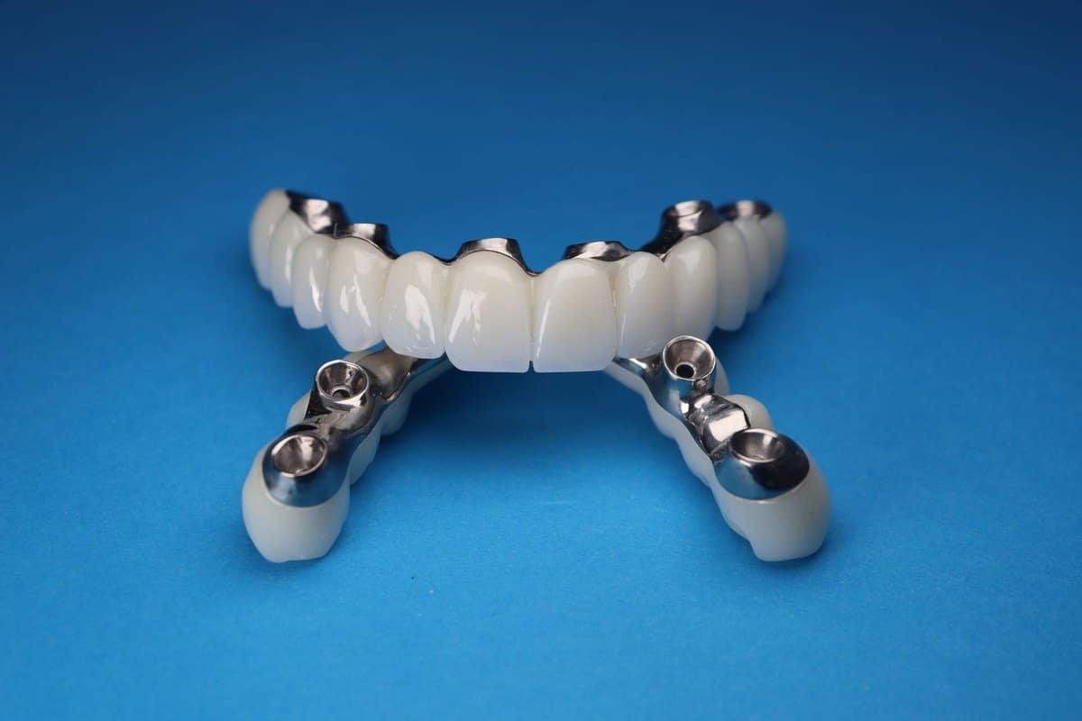 Puente de dientes sobre implantes dentales sobre un fondo azul