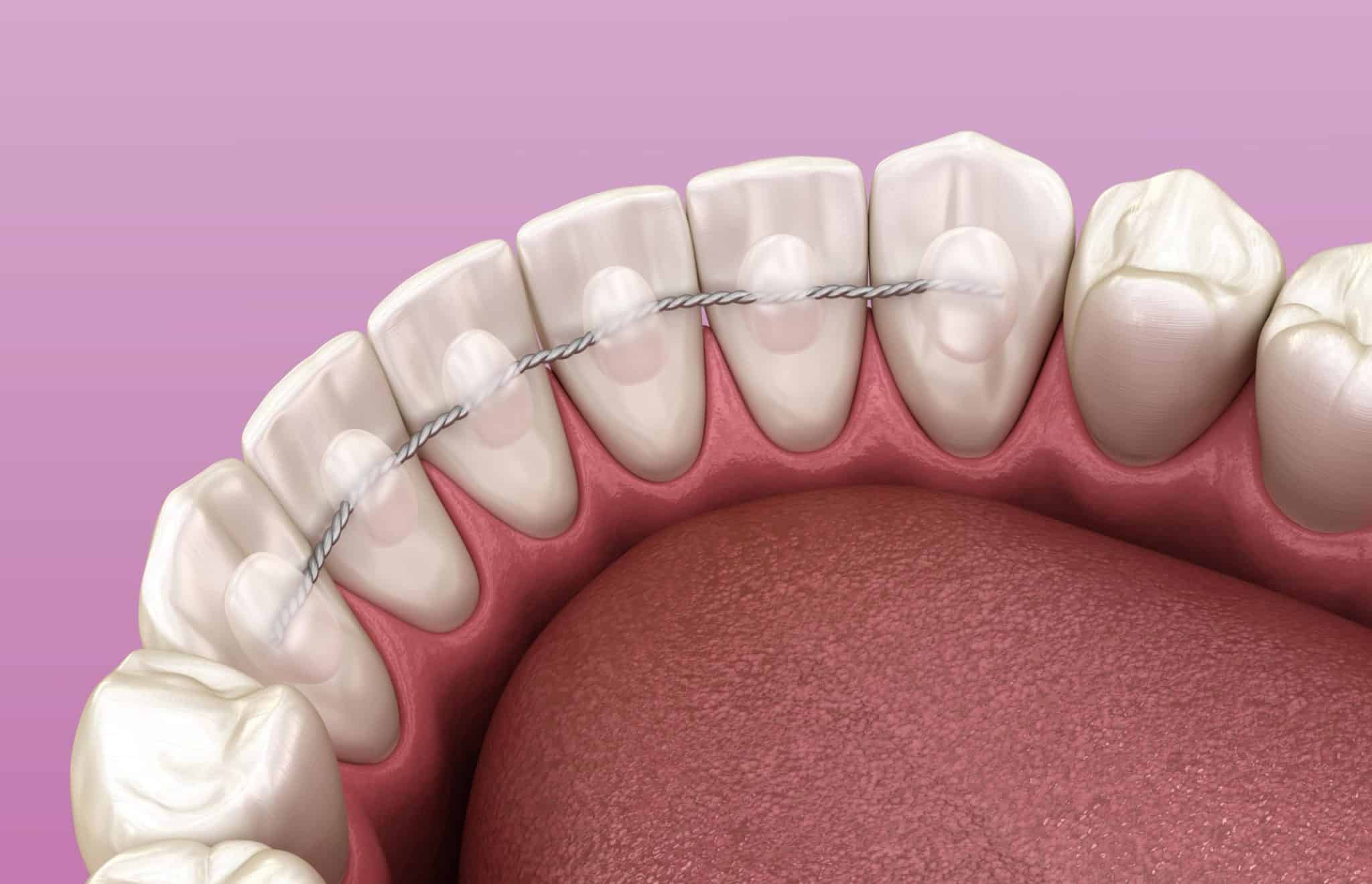 retenedores dentales fijos